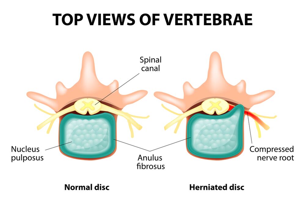 Disco intervertebral saudable e hernia