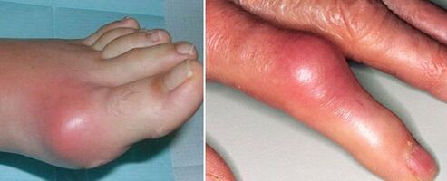 aparición de articulacións con artrite