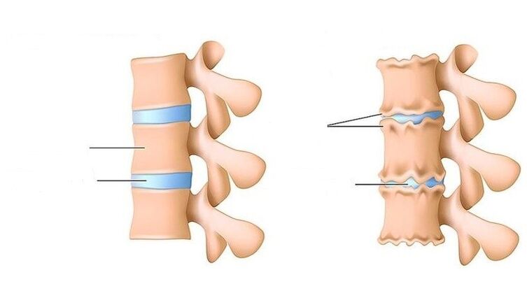 columna vertebral san e afectados pola osteocondrose
