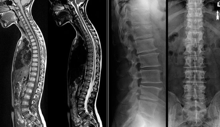 Imaxes de raios X e resonancia magnética para osteocondrose