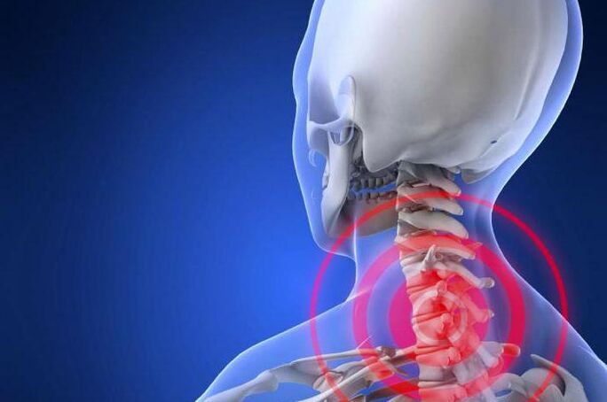 Dor de tiro no pescozo - un síntoma precoz da osteocondrose cervical