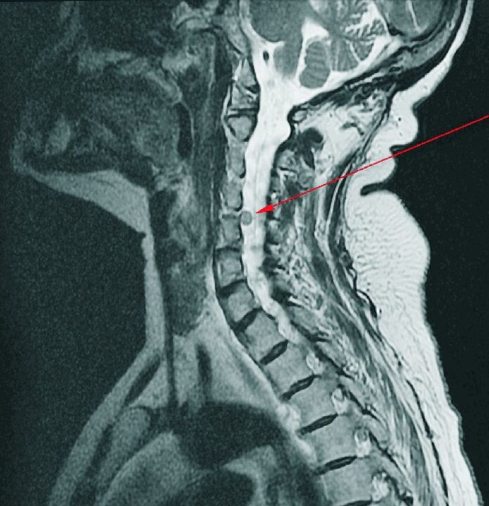 Hernia intervertebral da columna cervical na resonancia magnética