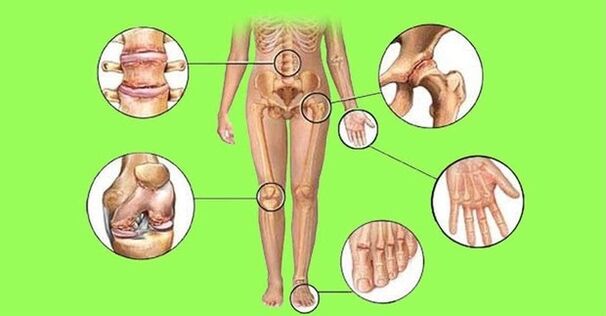 articulacións afectadas por artrite e artrose