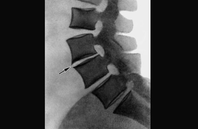 Manifestacións da osteocondrose da columna torácica na radiografía