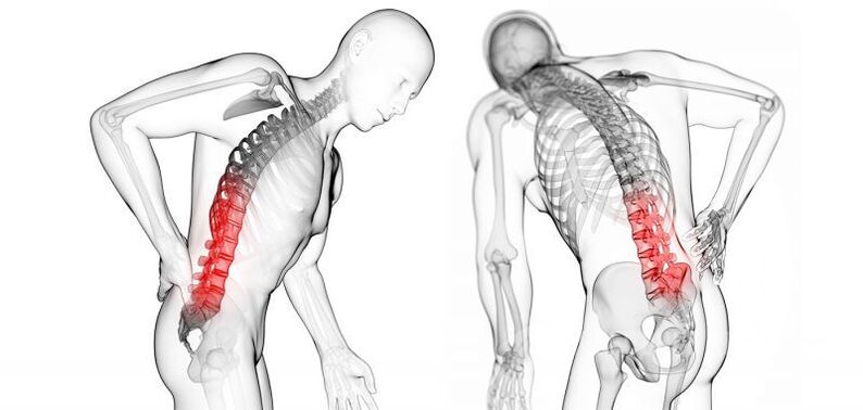 complicacións coa osteocondrose cervical