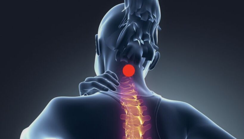 síntomas da osteocondrose cervical