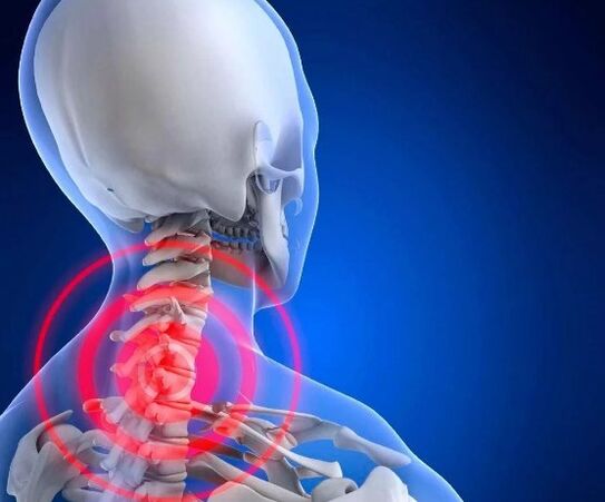 Osteocondrose cervical